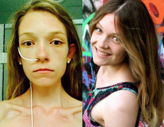 Garota que sofreu de anorexia luta contra a doença na web