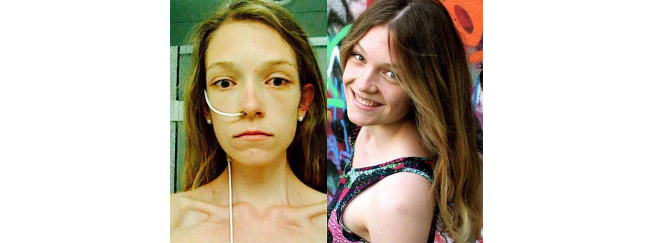 Garota que sofreu de anorexia luta contra a doença na web