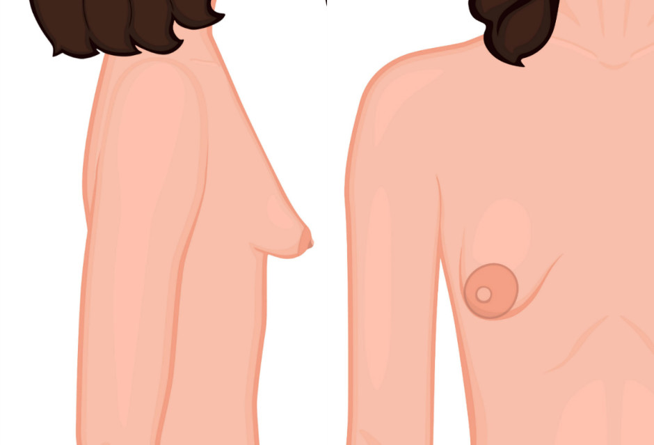 Mama tuberosa: o que é e como tratar a malformação dos seios