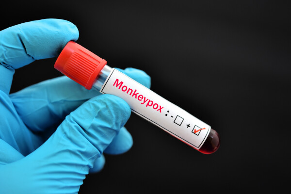Imagem aproximada de mão, usando luva azul, segurando um tubo de ensaio com etiqueta branca escrito "Monkeypox" e um resultado positivo para a doença.