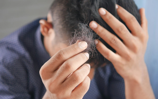 Imagem aproximada de homem com a cabeça abaixada enquanto segura um tufo de cabelo