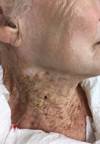 Imagem da foto do pescoço de uma idosa de 92 anos que só passava protetor solar no rosto, e não no pescoço, viralizou na internet. Foto: Reprodução