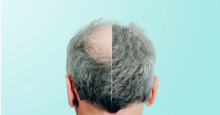 Alopecia androgenética (calvície): causas e como tratar