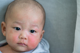 Bebê com quadro alérgico no rosto