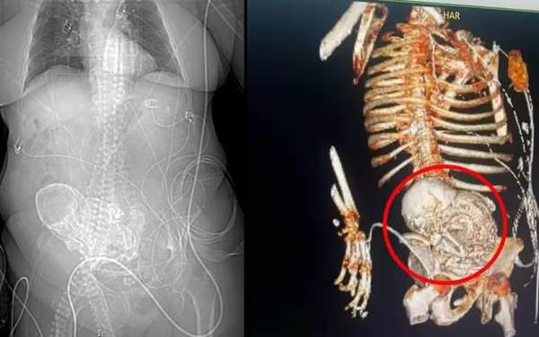 duas imagens, uma ao lado da outra, mostrando um bebê calcificado no estômago