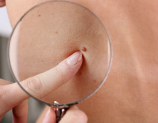Congresso Mundial de Dermatologia trouxe novidades sobre câncer de pele e celulite