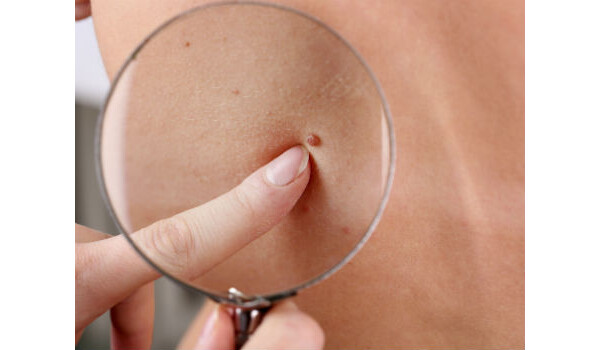 Congresso Mundial de Dermatologia trouxe novidades sobre câncer de pele e celulite