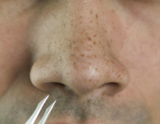 Pontinhos pretos no nariz podem ser reduzidos
