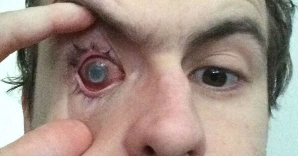 Homem fica cego depois de tomar banho com lentes de contato