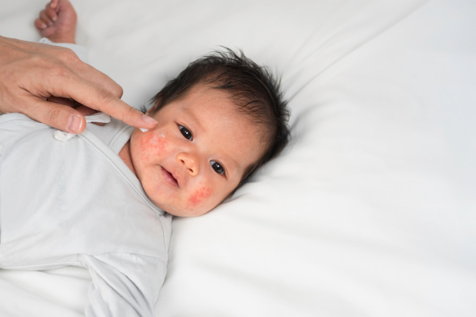 Bebê com dermatite atópica no rosto