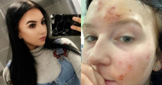 Mulher sofre queimadura química no rosto após usar cosmético