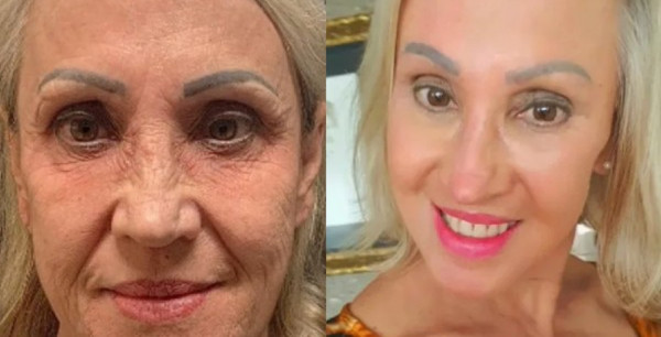 Como usar retinol e tretinoina para iniciantes e também para