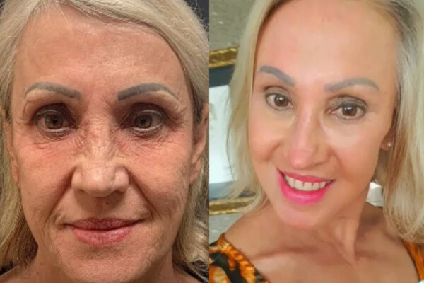 A esquerda, mulher idosa com rugas na pele. A direita, a mesma idosa com o rosto livre de rugas e linhas de expressão.