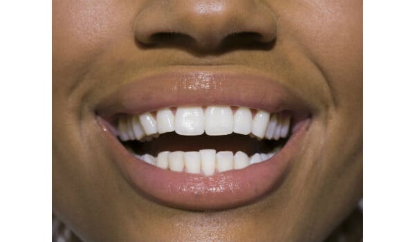 Dentes perfeitos: conheça suas características