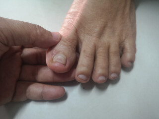 pessoa com micose nas unhas dos dedos do pé