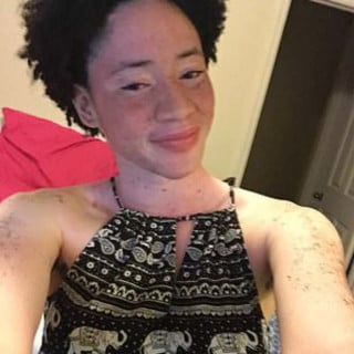 Jamila com o corpo já coberto pelo vitiligo - Foto: Reprodução/Facebook
