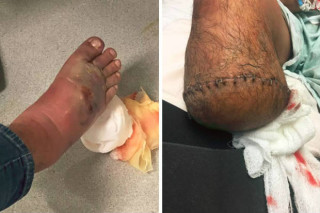 Homem precisa amputar o pé após infecção de bactéria devoradora de carne - foto: Divulgação/Buzzfeed
