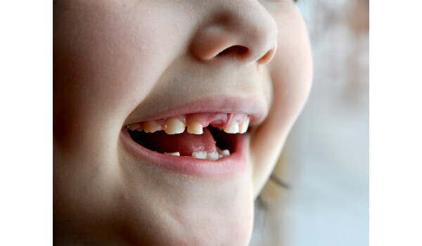 Dente de leite 'reserva' espaço para o dente permanente e deve ser bem cuidado desde o nascimento