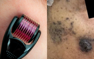 ao lado esquerdo, um dermaroller sendo passado sobre uma pele; do lado direito, uma pele com manchas escuras de melanoma