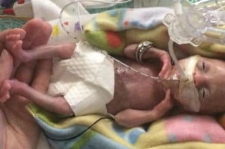 Menor bebê prematura do mundo completa três anos - foto: Divulgação/CNN