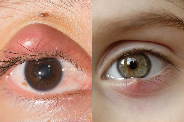 Você sabe a diferença entre terçol e calázio? – Hospital de Olhos