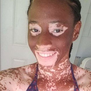 Jamila posta foto com redução do vitiligo, o que ela considera como resultado do veganismo - Foto: Reprodução/Facebook