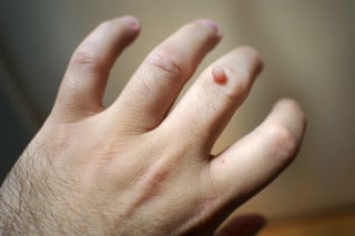 Mão de um adulto com verruga - Foto: Getty Images