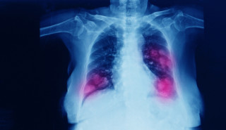Câncer de pulmão: 7 fatos que sobre a doença