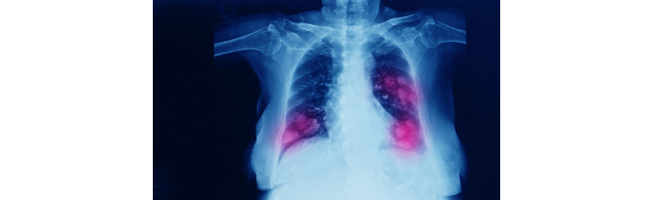 Câncer de pulmão: 7 fatos que sobre a doença