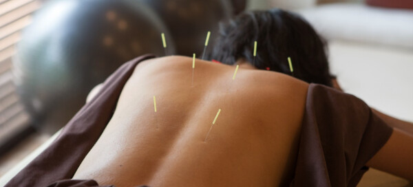Mulher fazendo tratamento de acupuntura