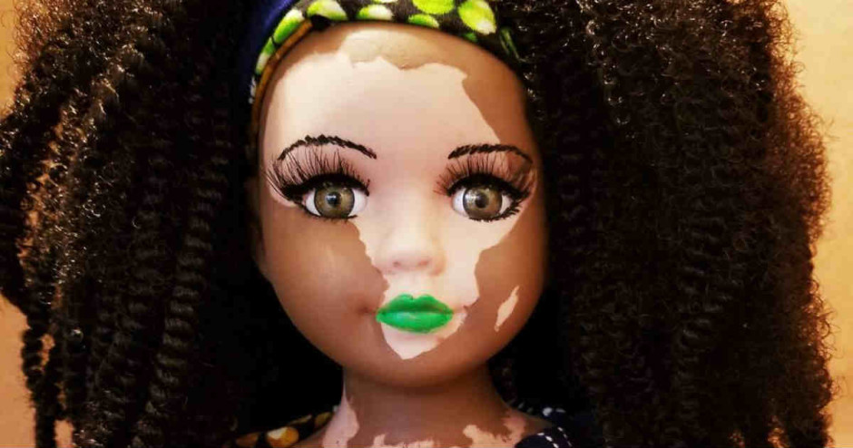 boneca-vitiligo