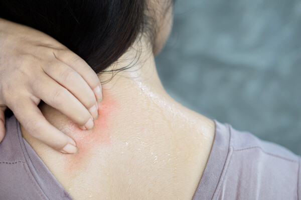 Alergia ao calor é um tipo raro de urticária que pede cuidados