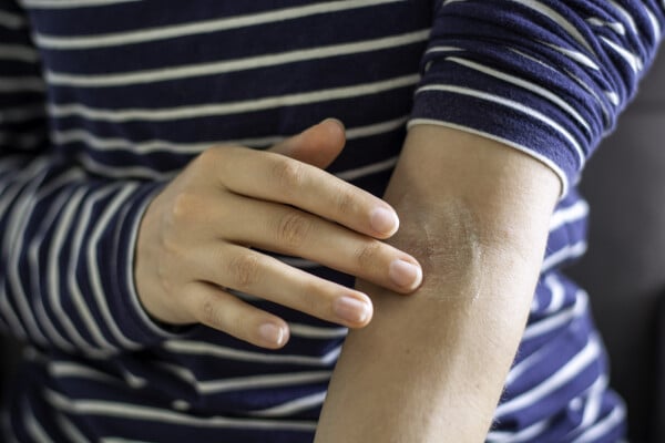 Close up em um individuo passando pomada no braço com dermatite
