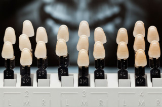 Dentes com diferentes matizes de base - Foto: Getty Images