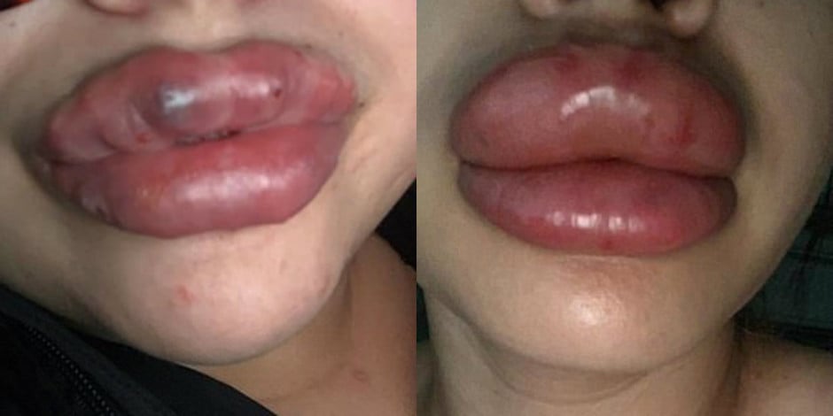 7 mulheres contraem infecção grave após preenchimento labial nos EUA