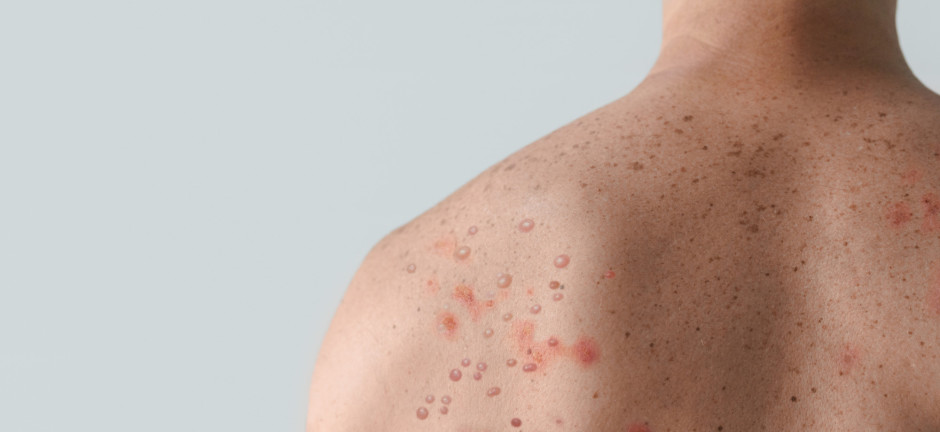 Foto aproximada de costas masculinas com lesões na pele, um dos sintomas de varíola dos macacos