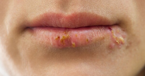 Imagem aproximada de boca repleta de feridas causadas pelo herpes labial