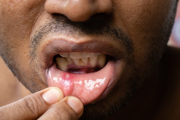 Close up de um homem com afta na boca