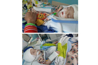 Gêmeos siameses Jadon e Anias McDonald após a cirurgia - foto: divulgação/Facebook