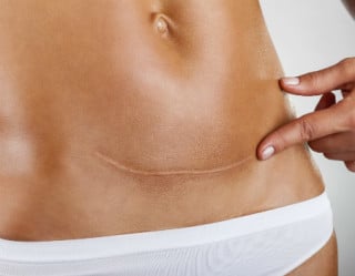 Cicatriz da abdominoplastia