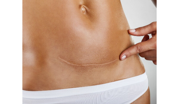 Cicatriz da abdominoplastia