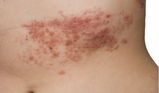Herpes Zóster - Foto: Getty Images