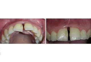 Imagens mostram pelos na boca de jovem, similares a cílios - Foto: Revista Oral Surgery, Oral Medicine, Oral Pathology and Oral Radiology