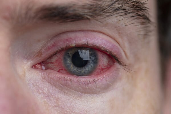 Imagem aproximada de olho irritado e avermelhado
