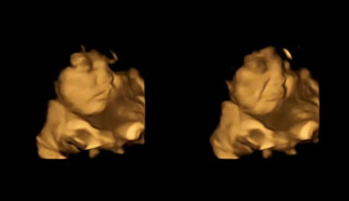 Reação neutra do bebê, à esquerda, e reação "cara de choro" do bebê, à direita. Foto:&nbsp;Durham’s Fetal Neonatal Research Lab/Divulgação