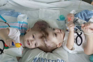 Gêmeos siameses Jadon e Anias McDonald antes da cirurgia - foto: divulgação/Facebook