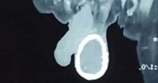 Homem tem testículo "casca de ovo" devido à elefantíase