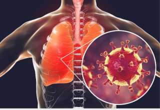 O coronavírus apresente sintomas semelhantes a uma pneumonia viral grave - Foto: Shutterstock