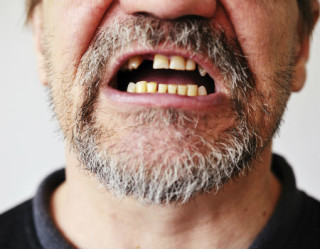 Estresse pode causar a queda dos dentes?