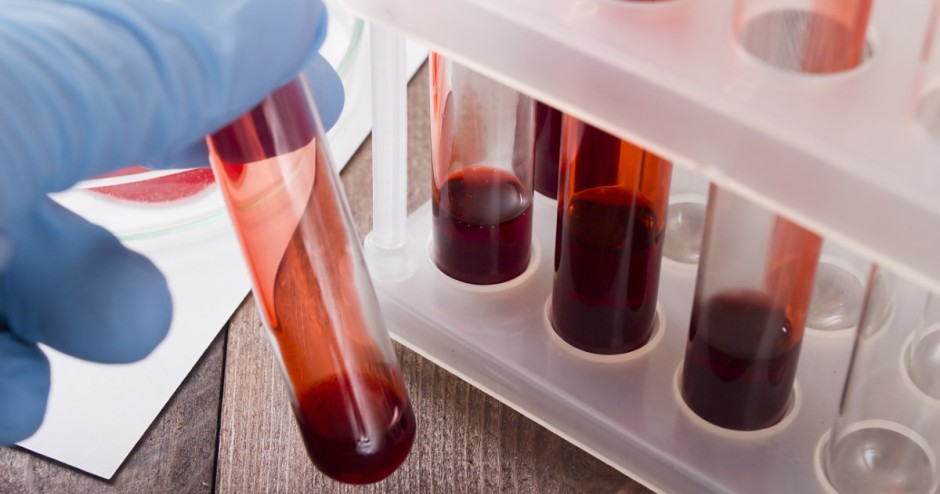 Novo exame de sangue pode diagnosticar câncer precocemente